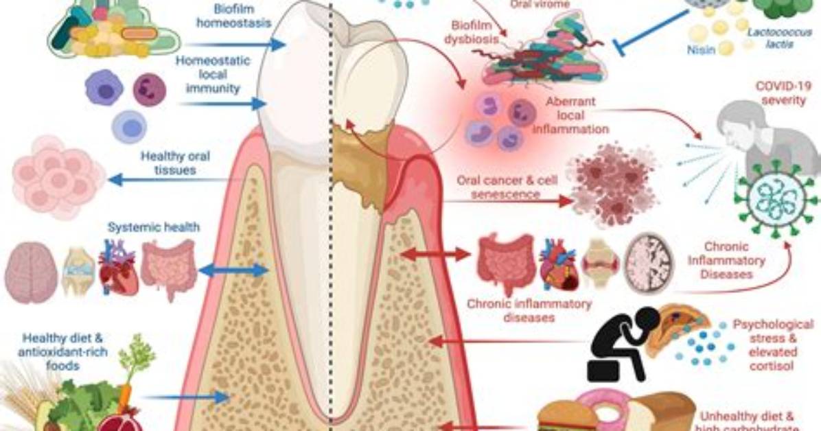 What Bacteria Causes Periodontitis
