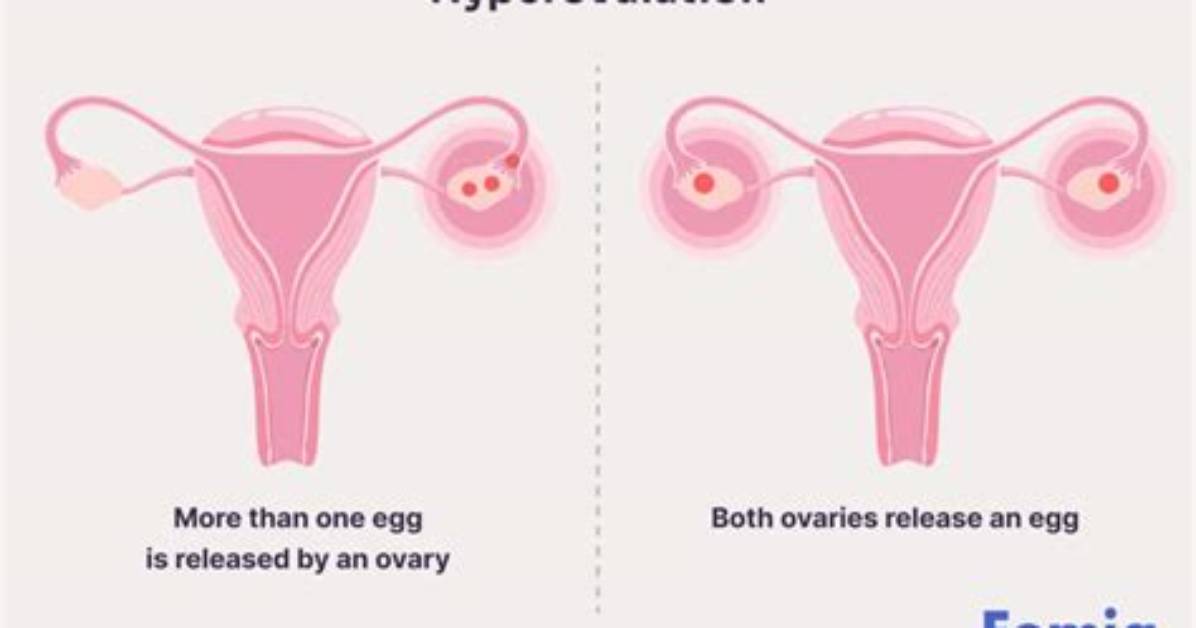 What Can Cause Hyperovulation