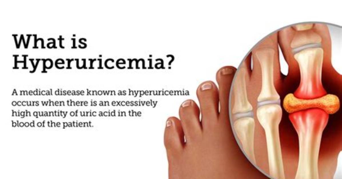 What Can Cause Hyperuricemia?