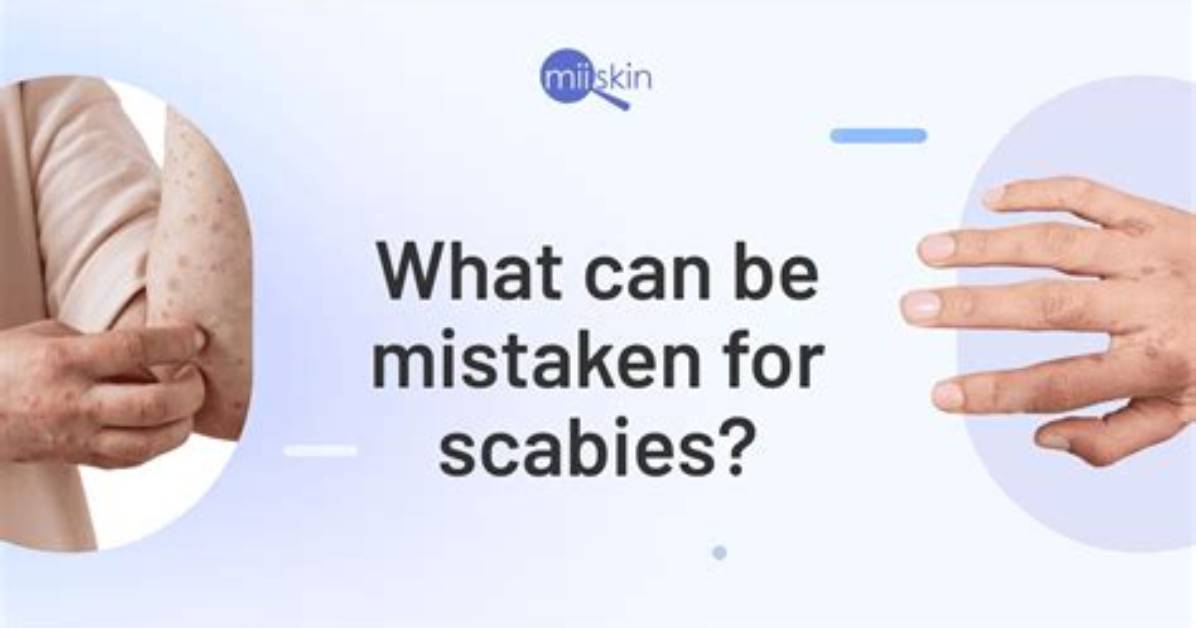 What Can Mimic Scabies
