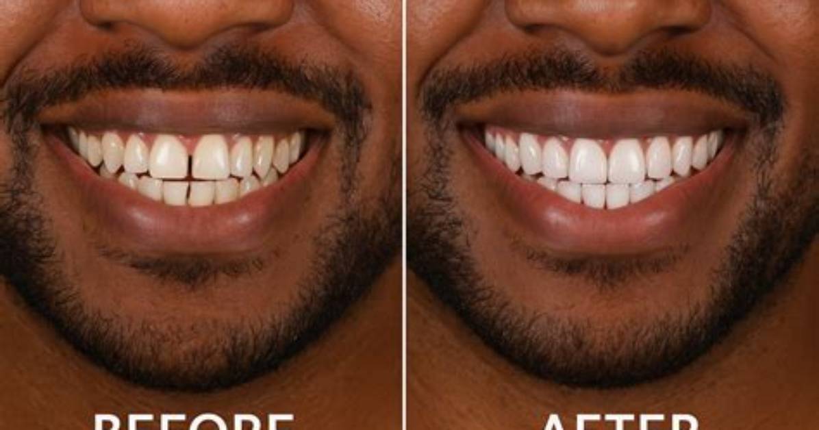 What Can Stop You from Getting Veneers?