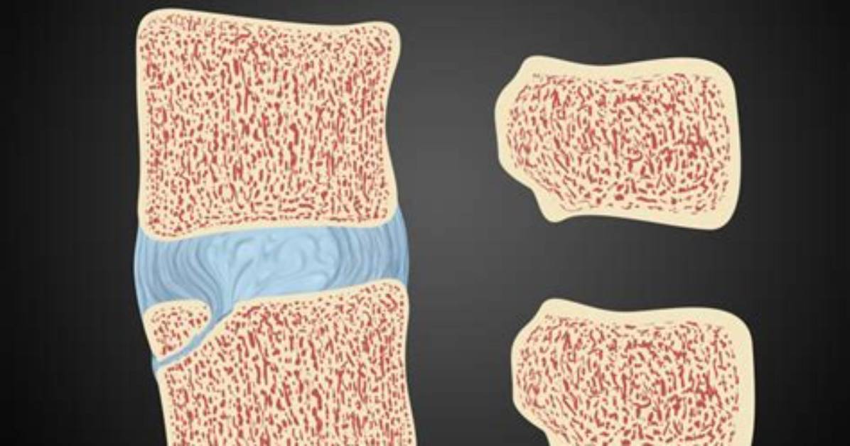What Causes a Limbus Vertebra
