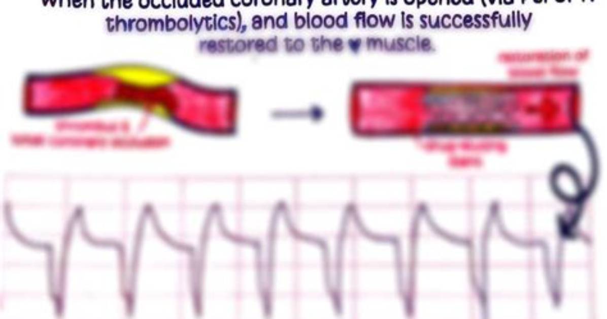 What Causes Aivr
