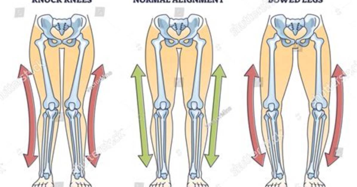 What Causes Bowed Knee?