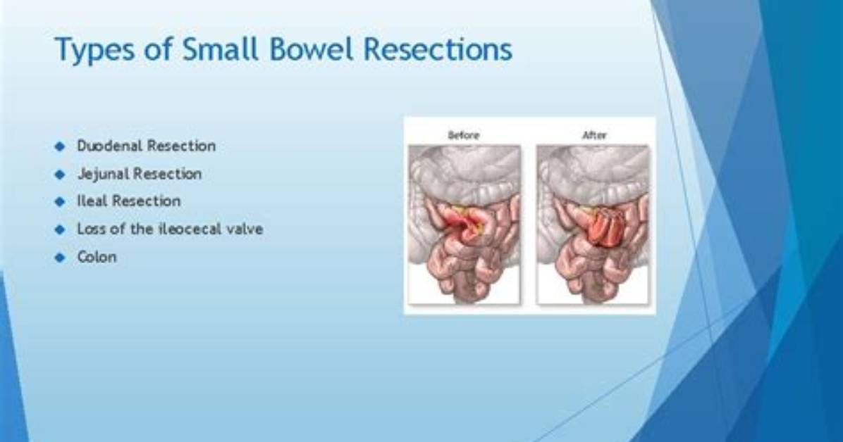 What Causes Bowel Resections?