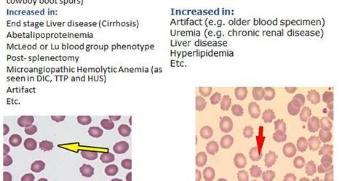What Causes Burr Cells