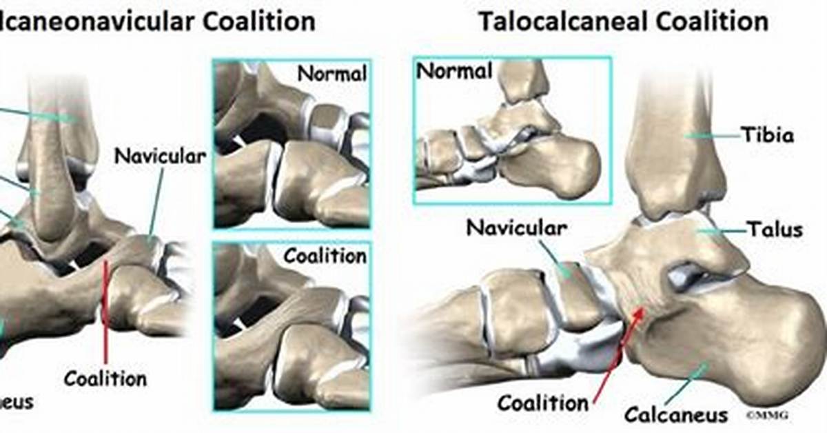 What Causes Calcaneonavicular Coalition? | Contextresponse. Com