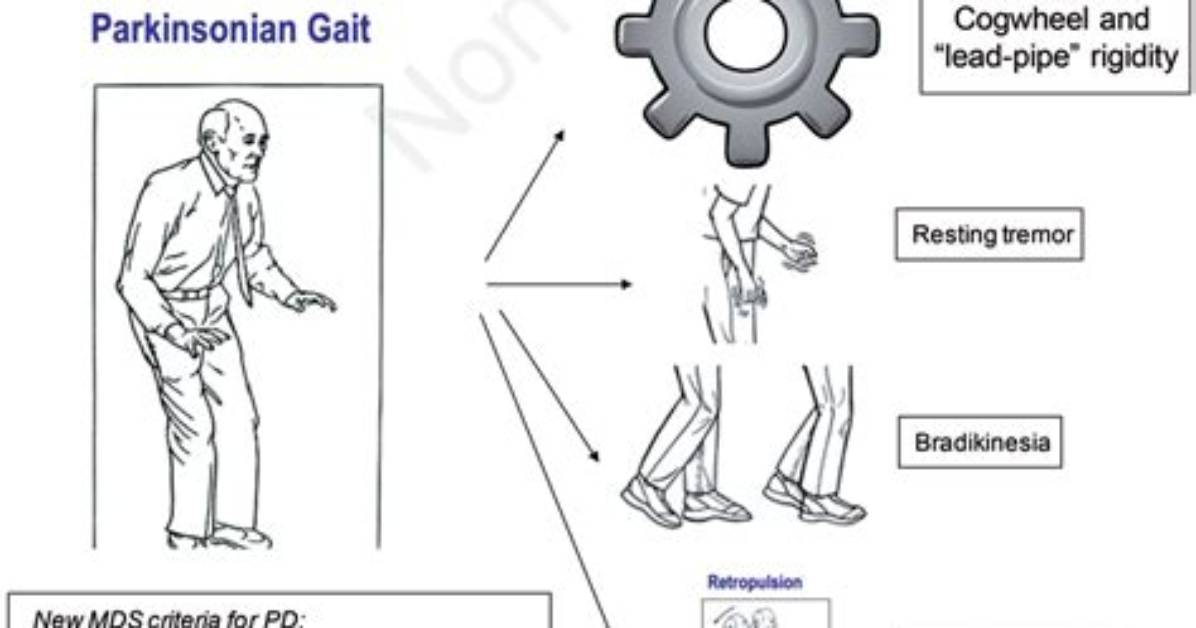 What Causes Cogwheel Rigidity?