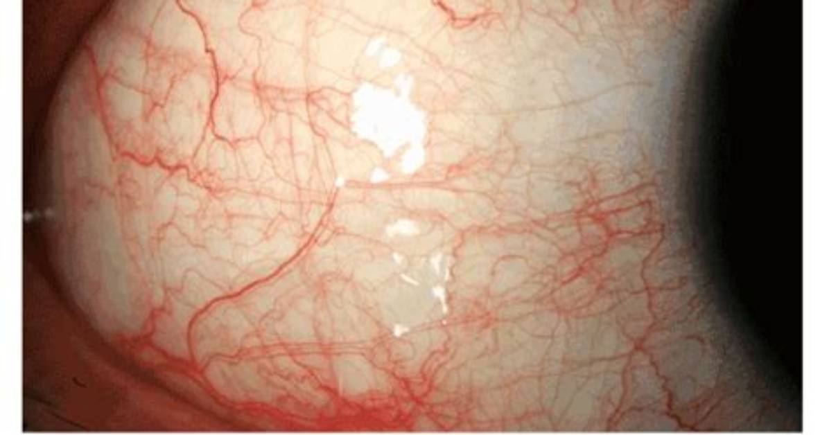 What Causes Conjunctival Hyperemia?
