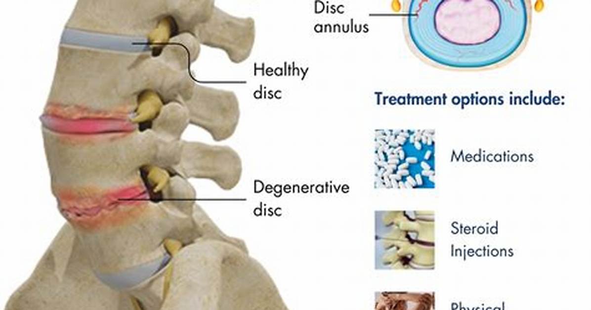 What Causes Deteriorated Disc?