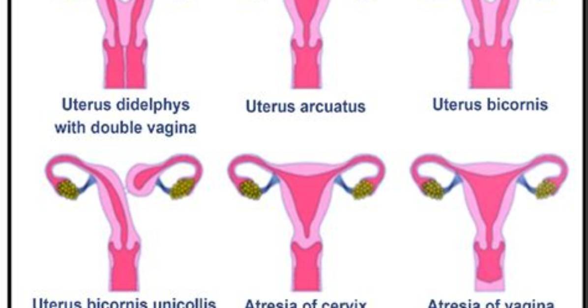 What Causes Didelphic Uterus?