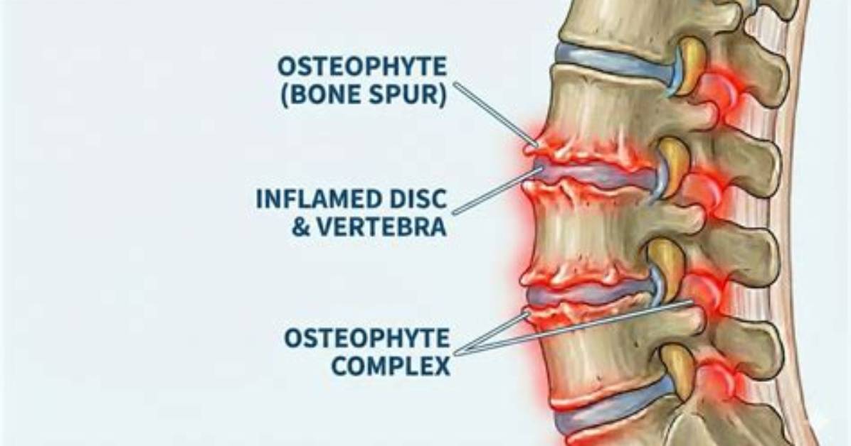 What Causes Disc Osteophyte