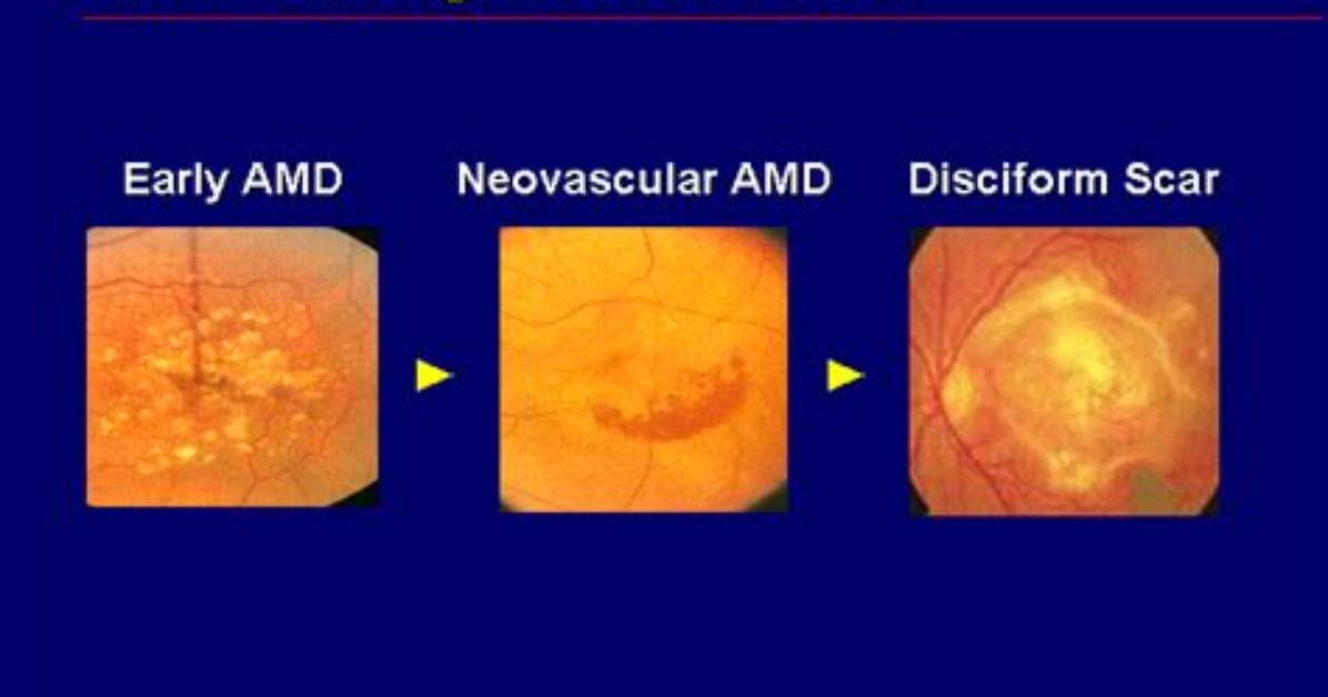 What Causes Disciform Scar?