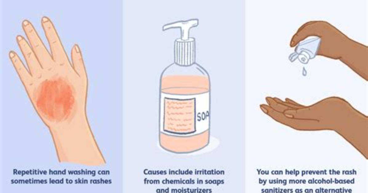 What Causes Dishpan Hands?