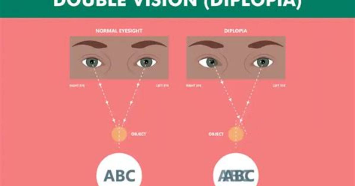 What Causes Double Vision