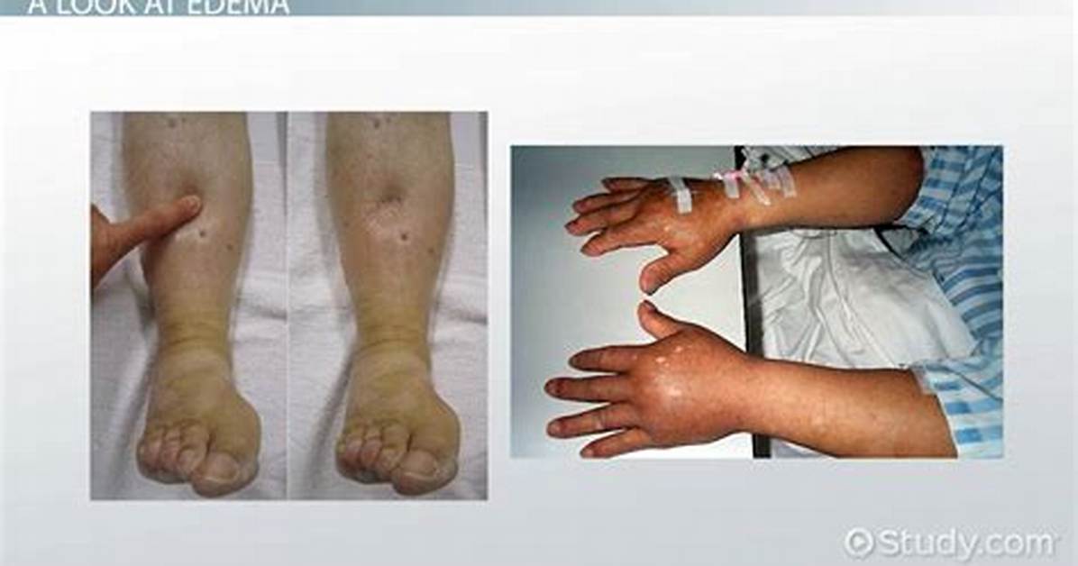 What Causes Edematous