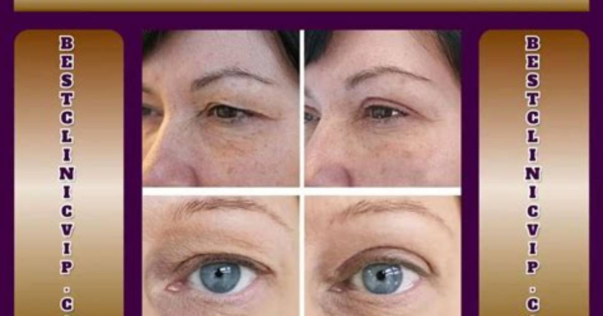 What Causes Eye Shrinkage