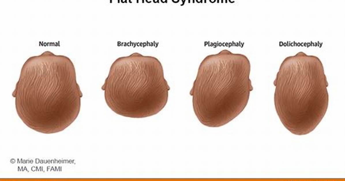 What Causes Flat Head Syndrome?