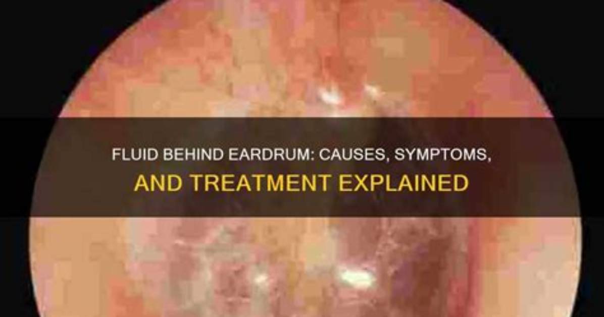 What Causes Fluid Behind Eardrum?