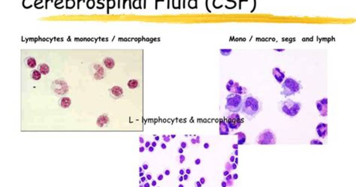 What Causes High Lymphocytes in Csf