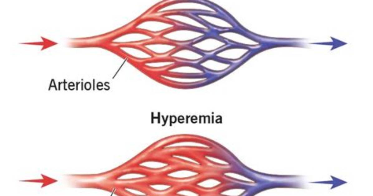 What Causes Hyperaemia