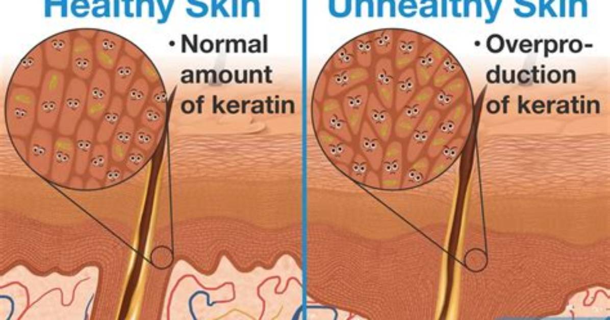 What Causes Hyperkeratinization