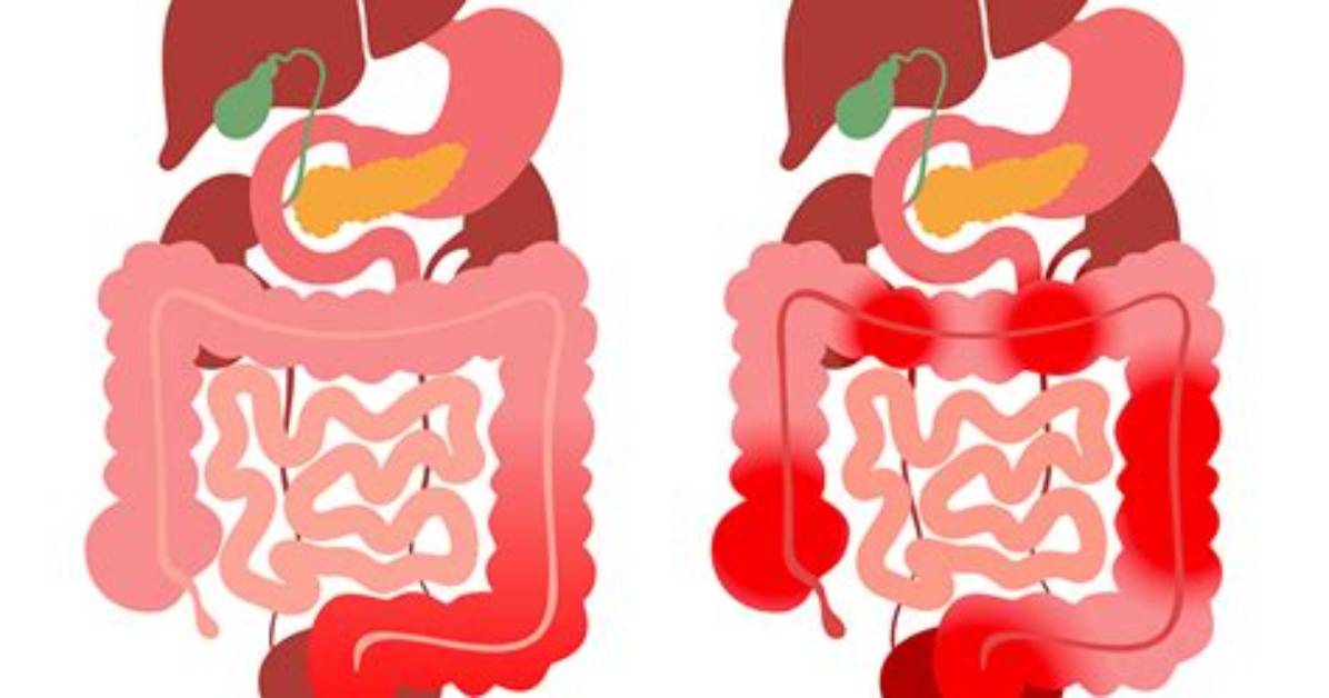 What Causes Ibd