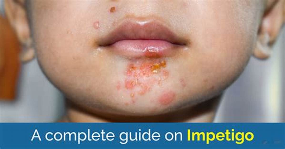 What Causes Impetigo