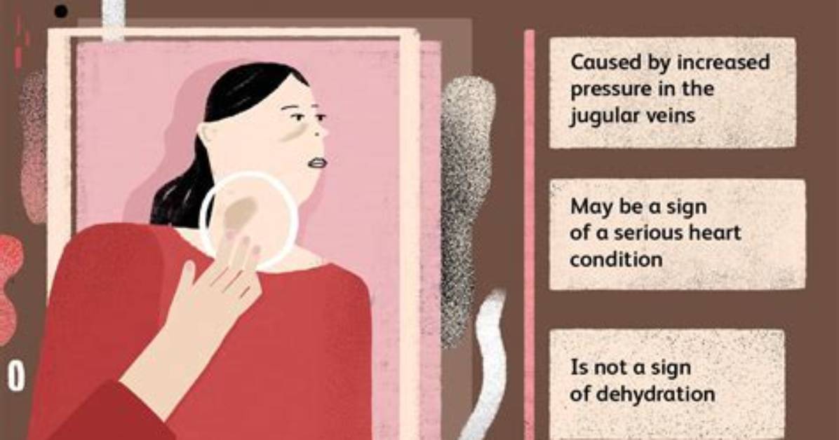 What Causes Increased Jvd