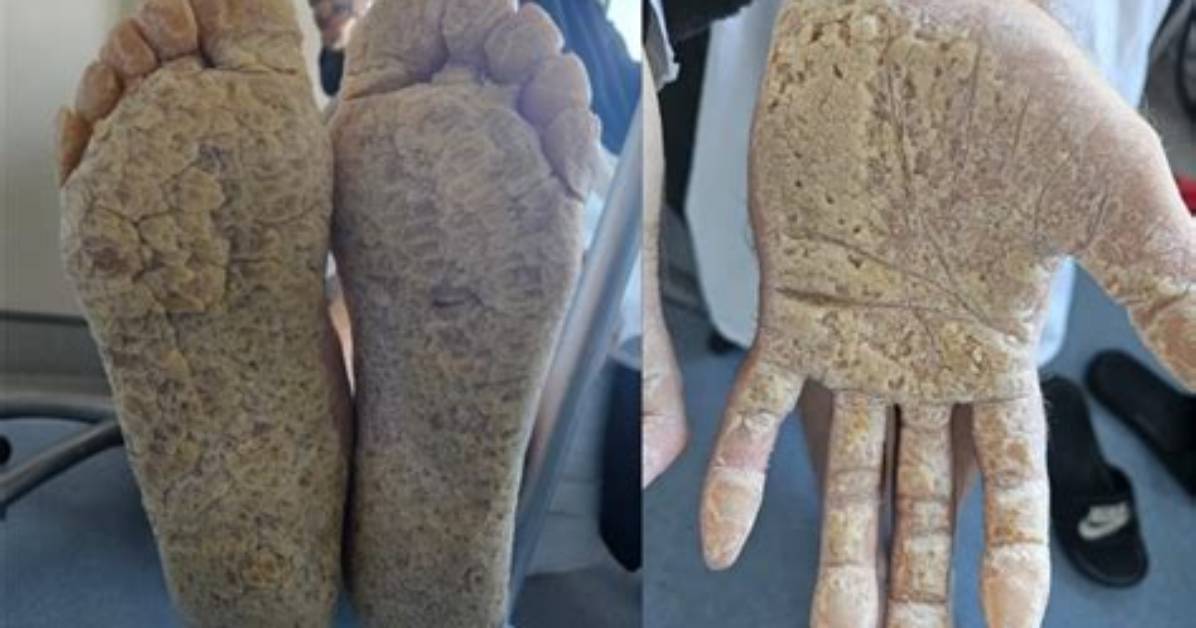 What Causes Keratoderma