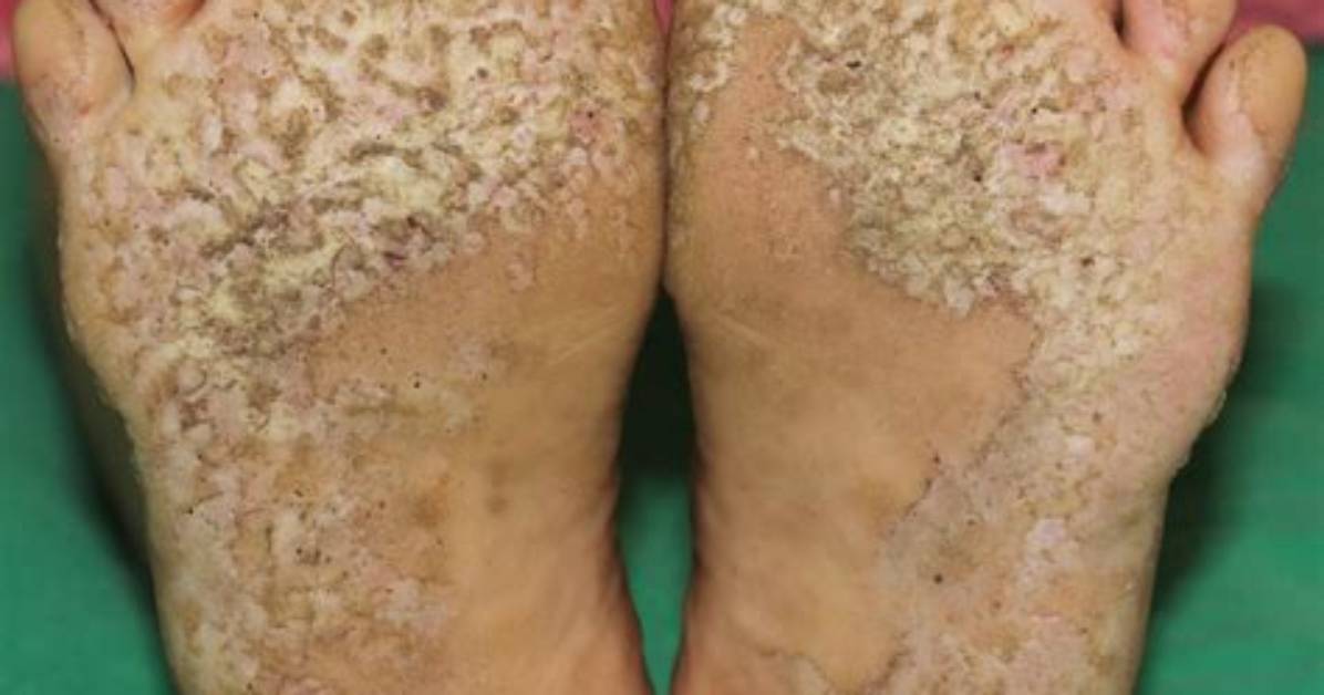 What Causes Keratolysis? | Contextresponse. Com