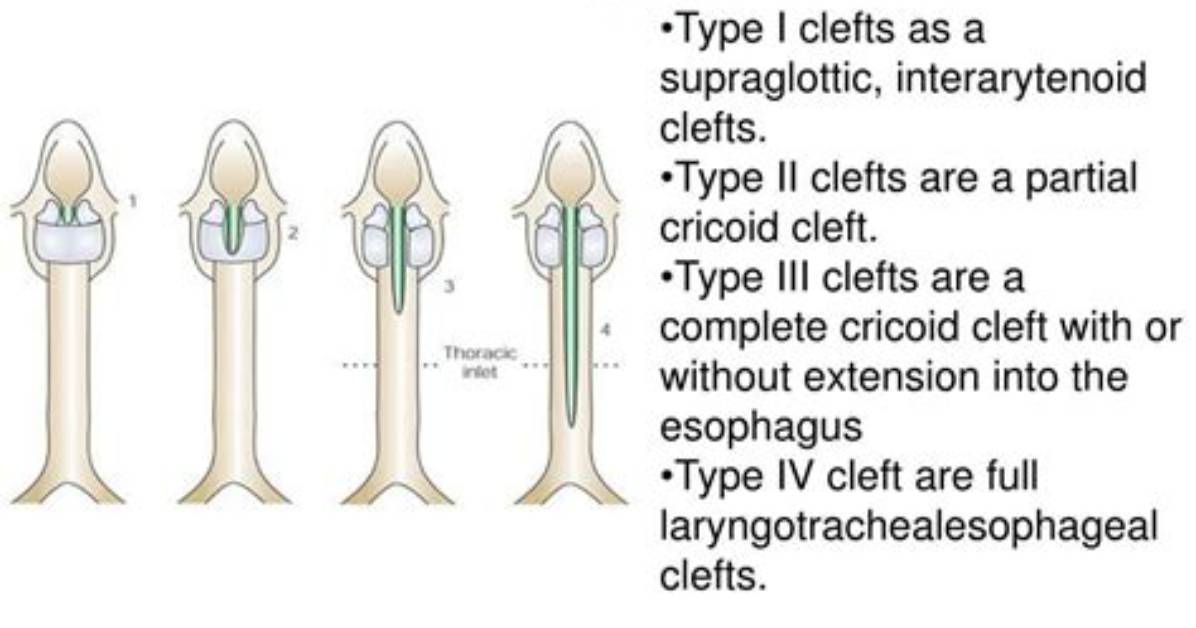 What Causes Laryngeal Cleft