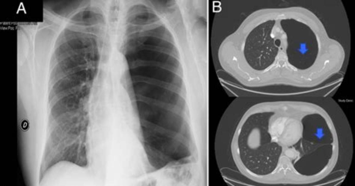 What Causes Lung Blebs