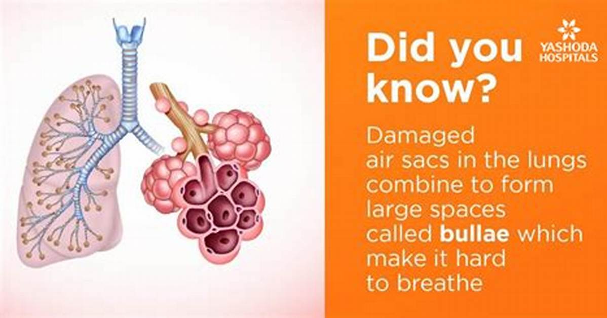 What Causes Lung Bulla