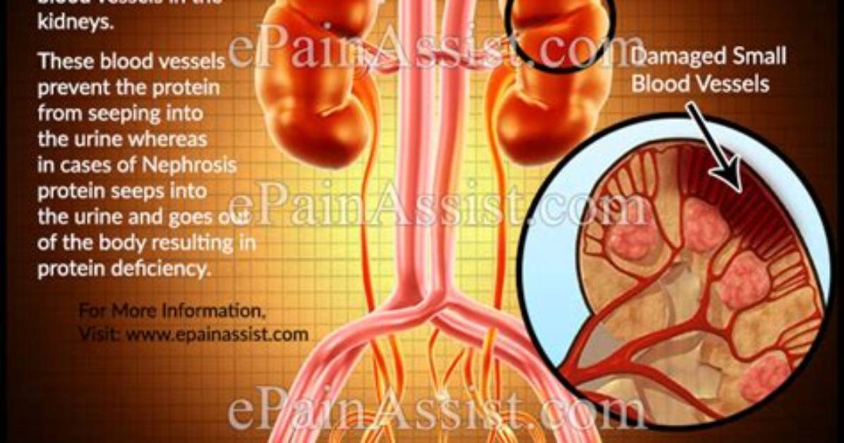 What Causes Nephrosis