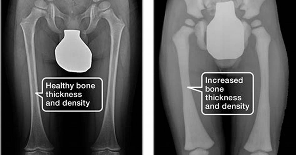 What Causes Osteopetrosis