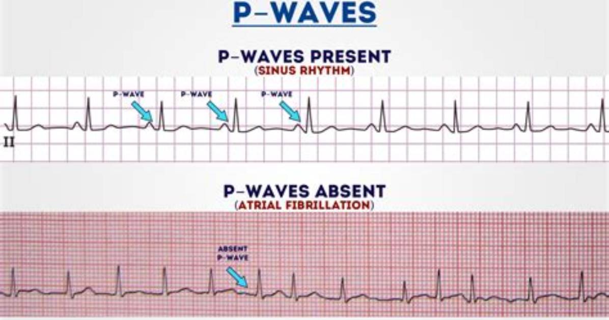 What Causes P Waves