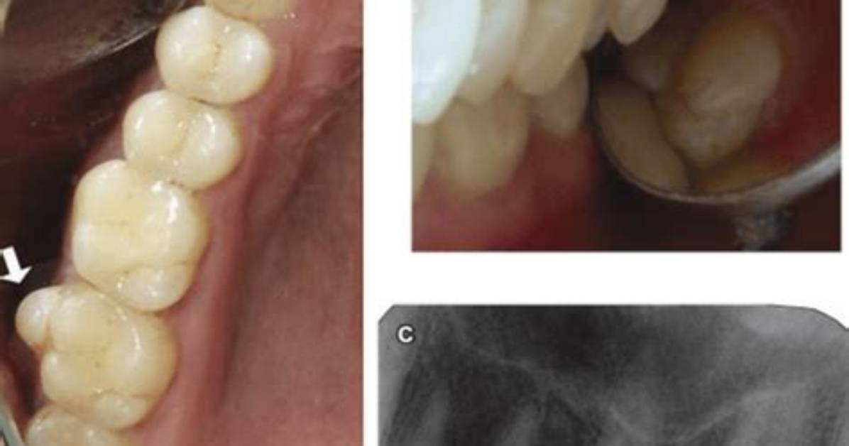 What Causes Paramolar