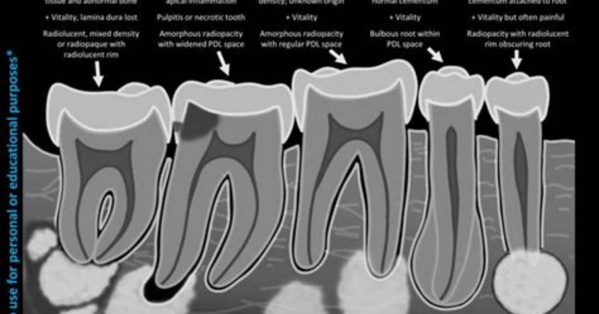 What Causes Periapical Radiolucency?
