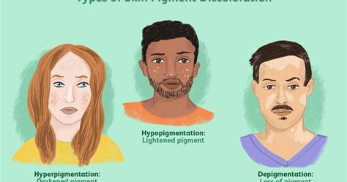 What Causes Pheomelanin