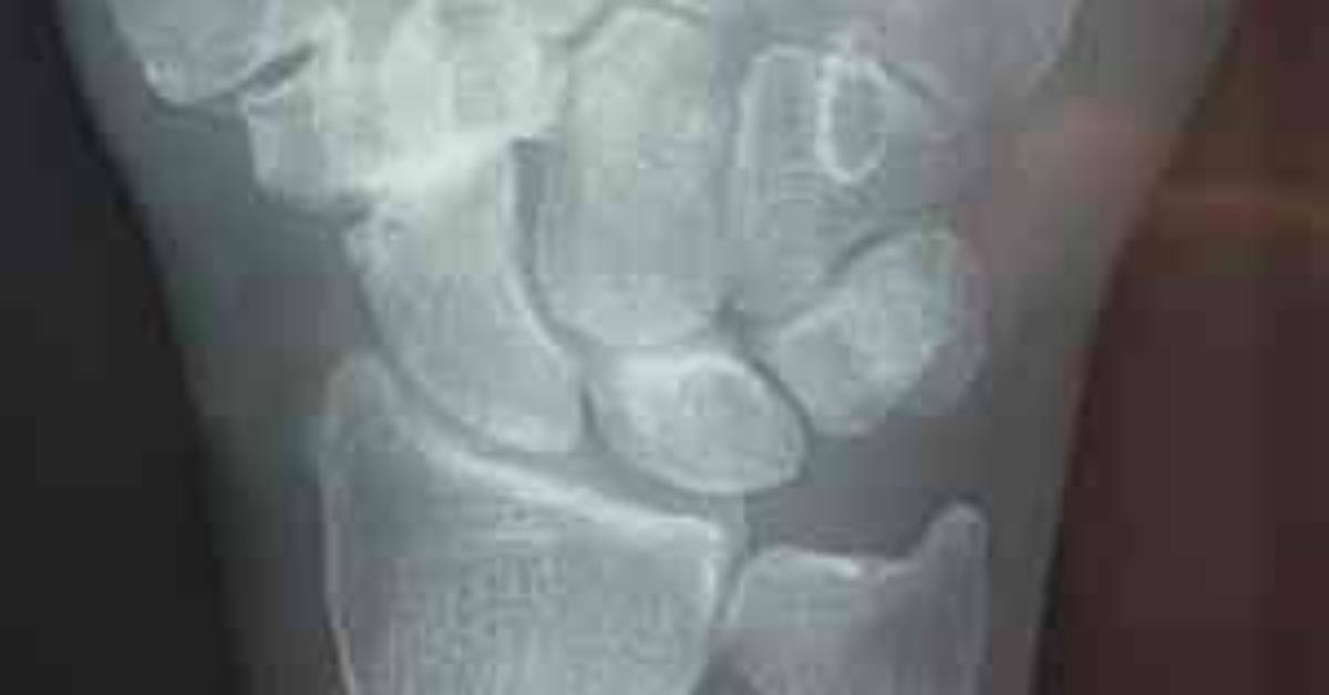 What Causes Preiser's Disease?