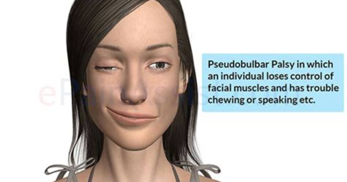 What Causes Pseudobulbar