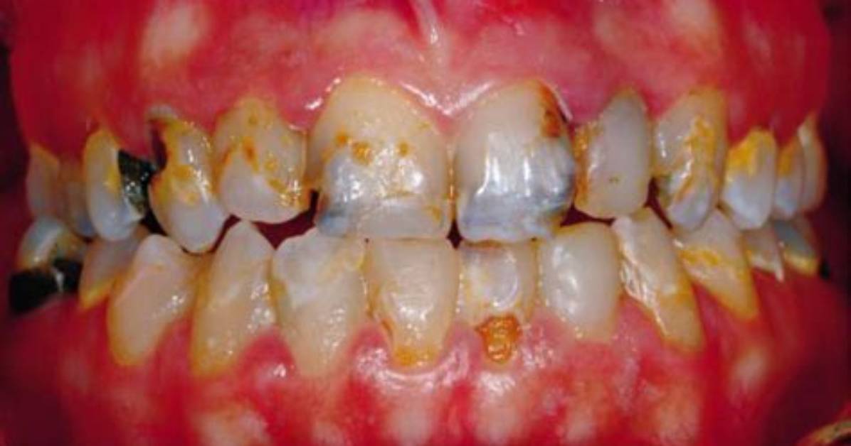 What Causes Rampant Caries