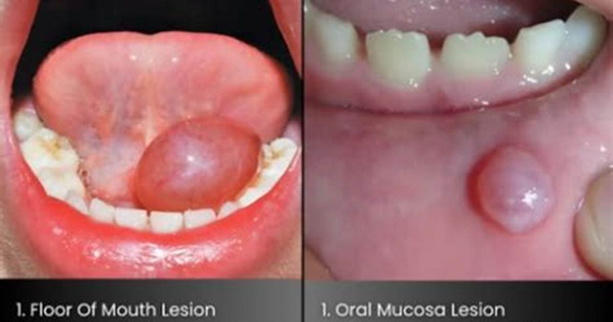 What Causes Ranula