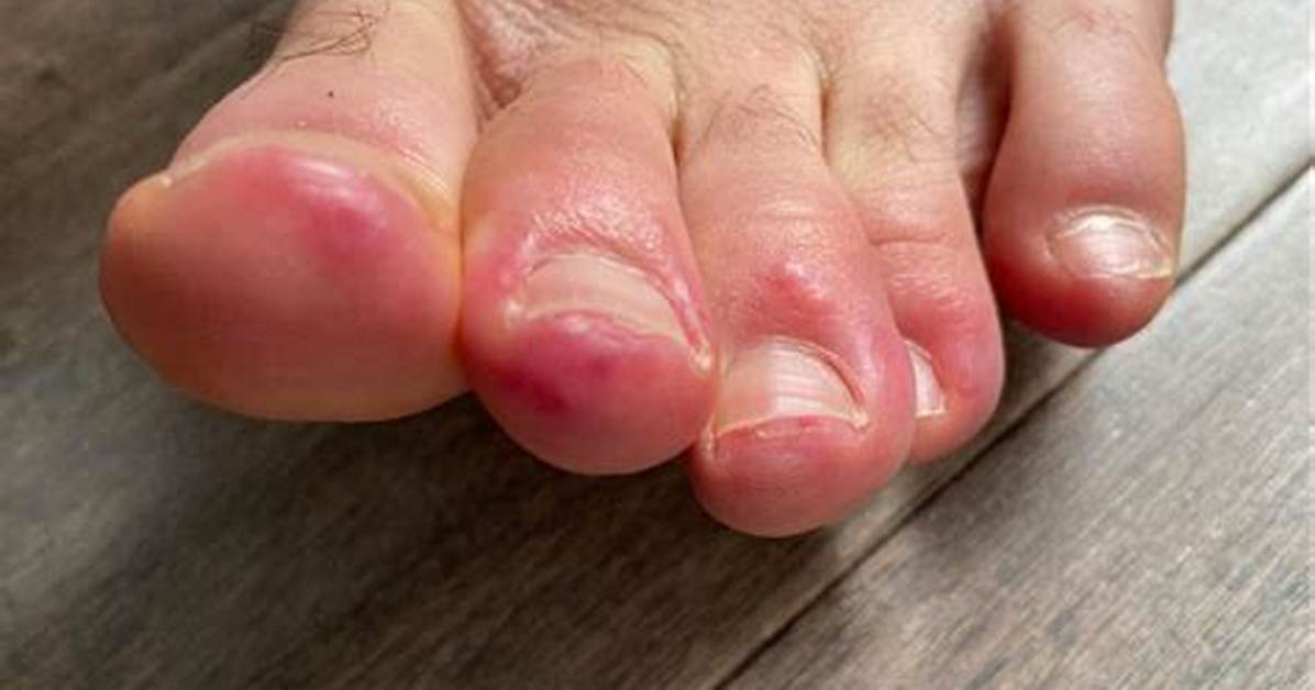 What Causes Redness Between Toes?