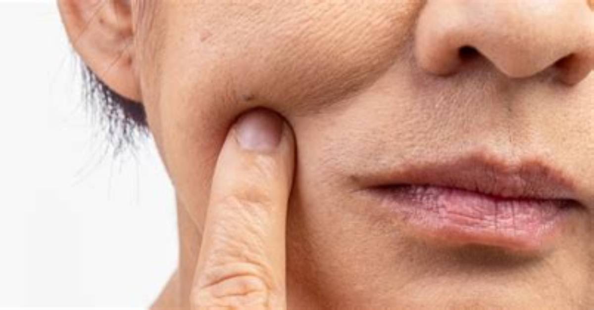 What Causes Rough Face?
