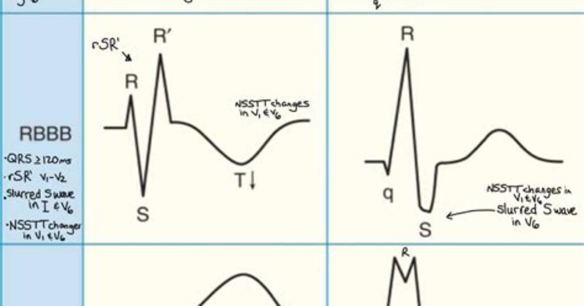 What Causes rSr
