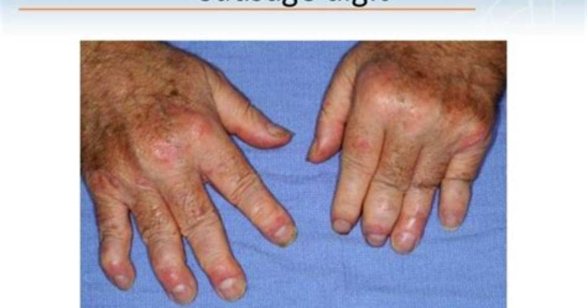 What Causes Sausage Digits?