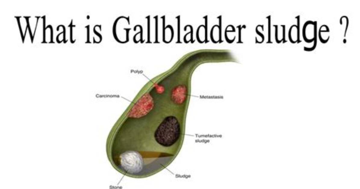 What Causes Sludge in the Gallbladder