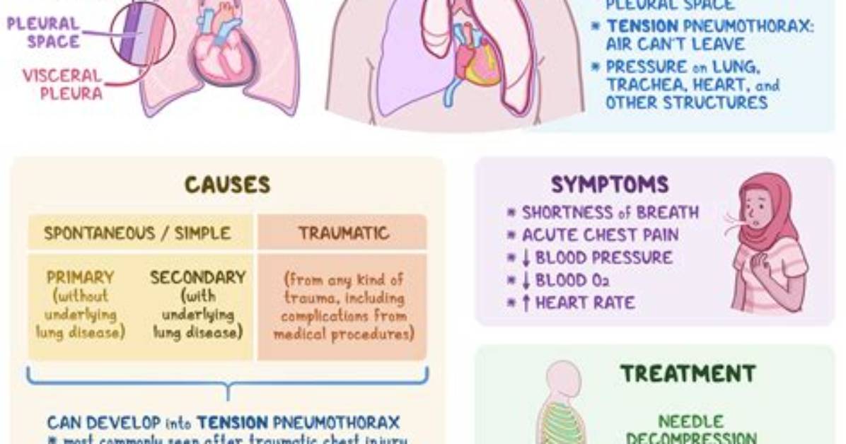 What Causes Spontaneous Hydropneumothorax?
